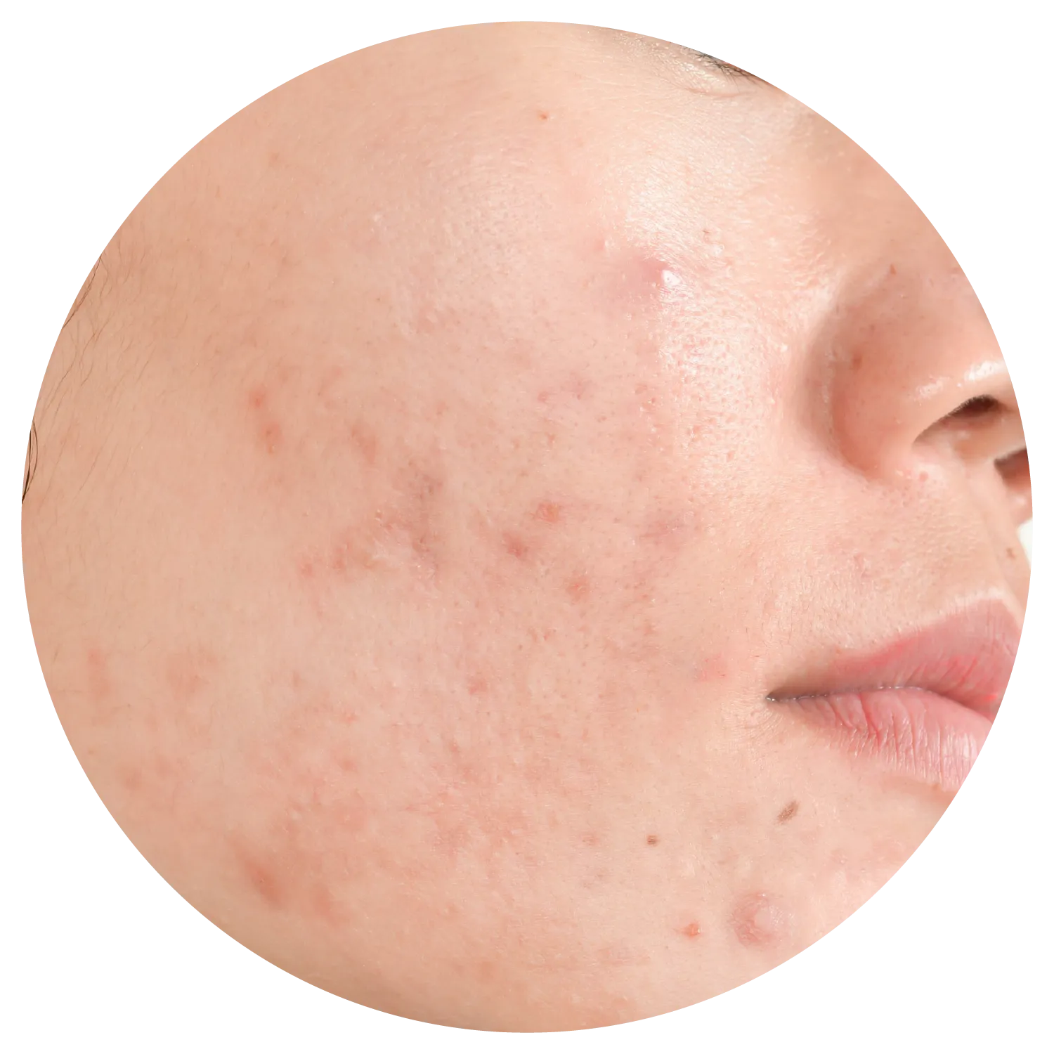 Active Acne treatment process at Toronto medical spa - Understand the deeper causes of acne.